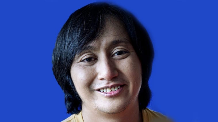 Mata Jadi Kabur Gelap, Radhi OAG Disahkan Hidap Katarak 